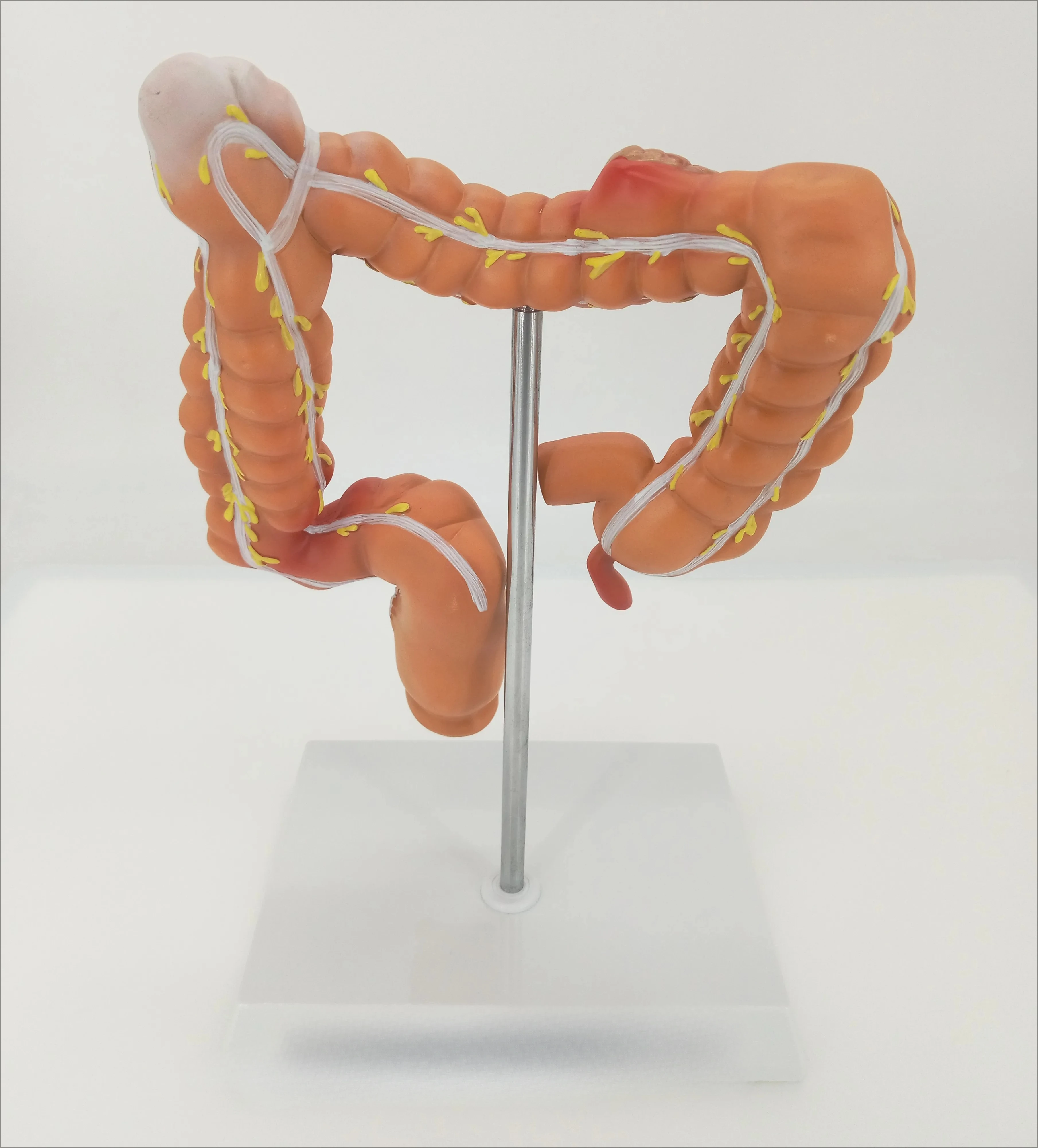 Colon pathological model Colorectal lesions specimens Intestinal anatomy model