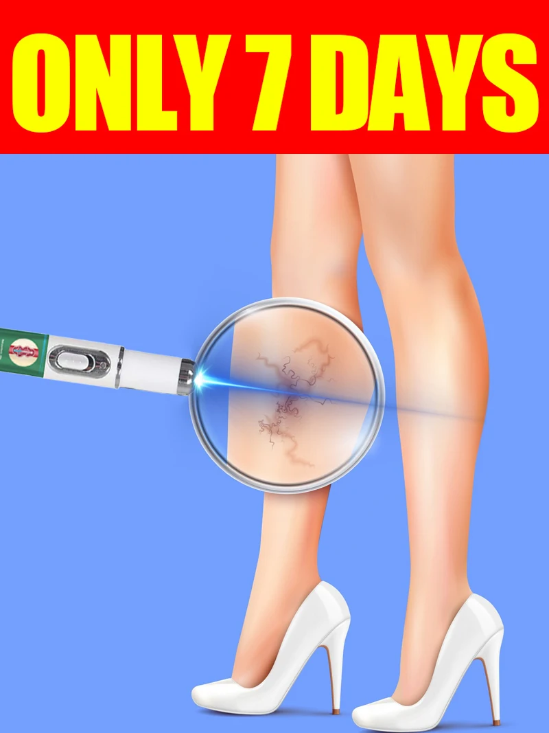 Laser generacji 3 pożegna się z żylakami w 7 dni