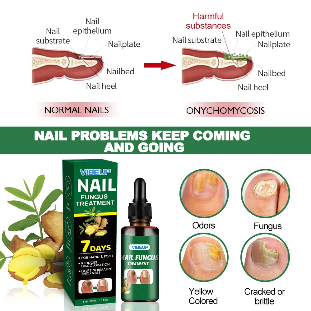 7 أيام الفطرية علاج الأظافر مصل القدم فطريات الأظافر إزالة إصلاح هلام مكافحة العدوى الداحس فطار القدم العناية بالأظافر