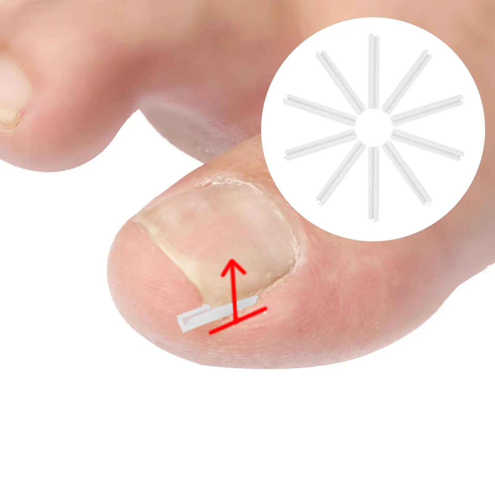 شرائط مصحح أظافر القدم الغارزة، مصحح أظافر القدم المنحني للعناية بالقدم