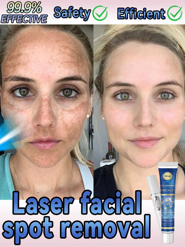 Nano laser Facial spots are gone