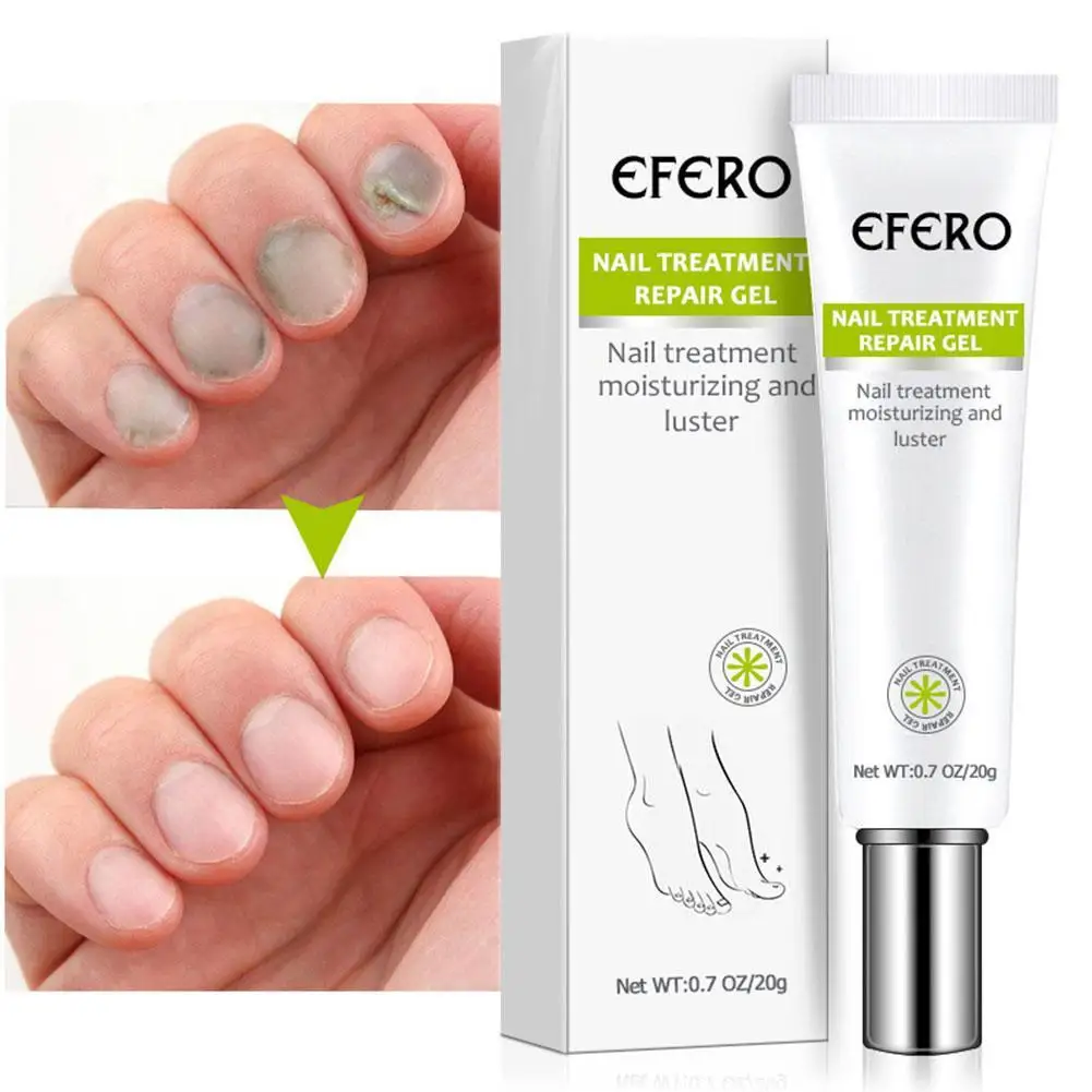 Fungal Nail Treatment Gel Foot Nail Fungus Removal Gel Anti Nails Foot Repair Gel Care Onychomycosis Infection Paronychia Y0M8