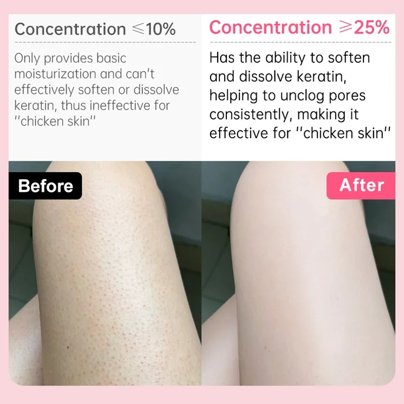 Removal Chicken Skin Body Lotion Treatment Keratosis Pilaris Lotion Rough Bumpy Pore Spots Care Moisturizer Whitening Creams 60g