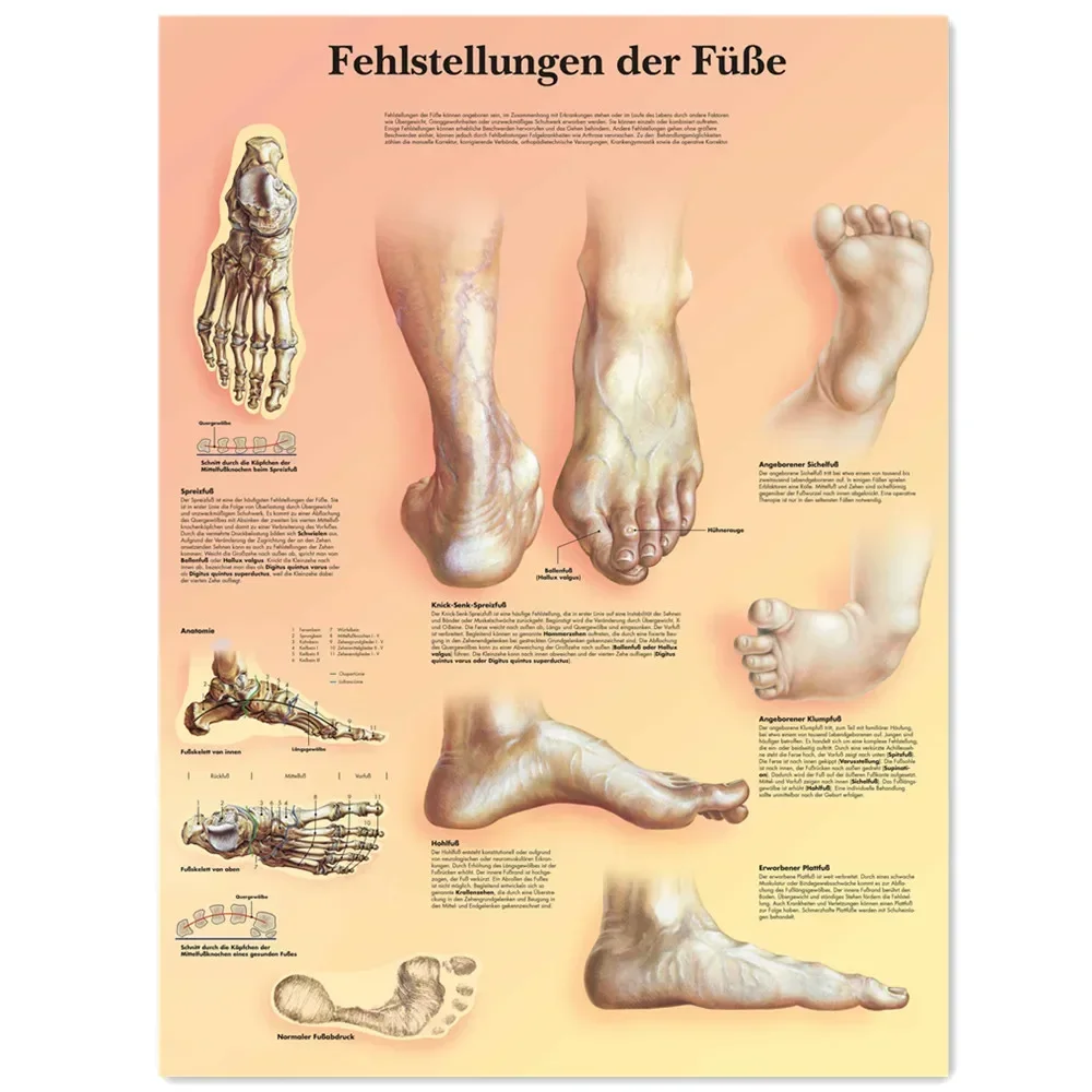 Foot malformations Vintage Kraft Paper Wall Art Painting Human Anatomy Medical Posters & Prints Wall Stickers Home Decor Chart