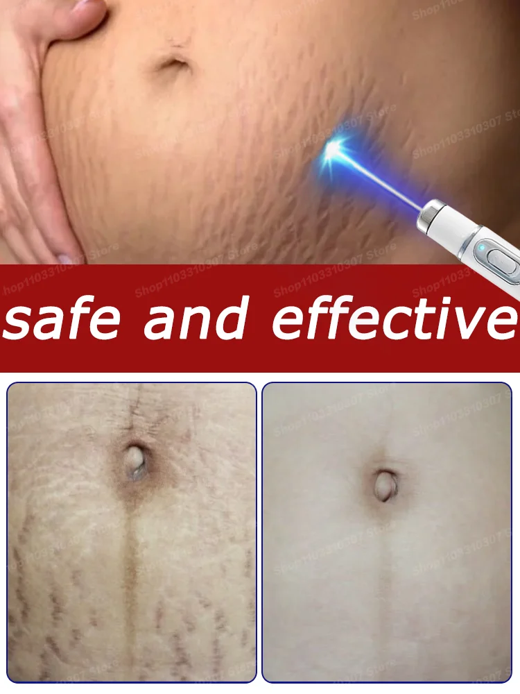 Improve Red White Old Stretch Marks