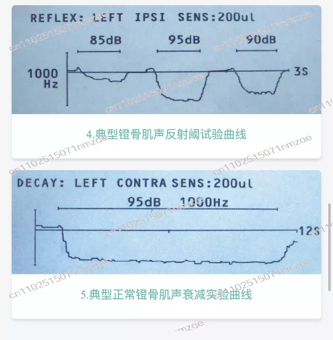 Acoustic Impedance Meter Hearing Detector Acoustic Conductance Middle Ear Analyzer Acoustic Impedance Pure Tone Audiometer
