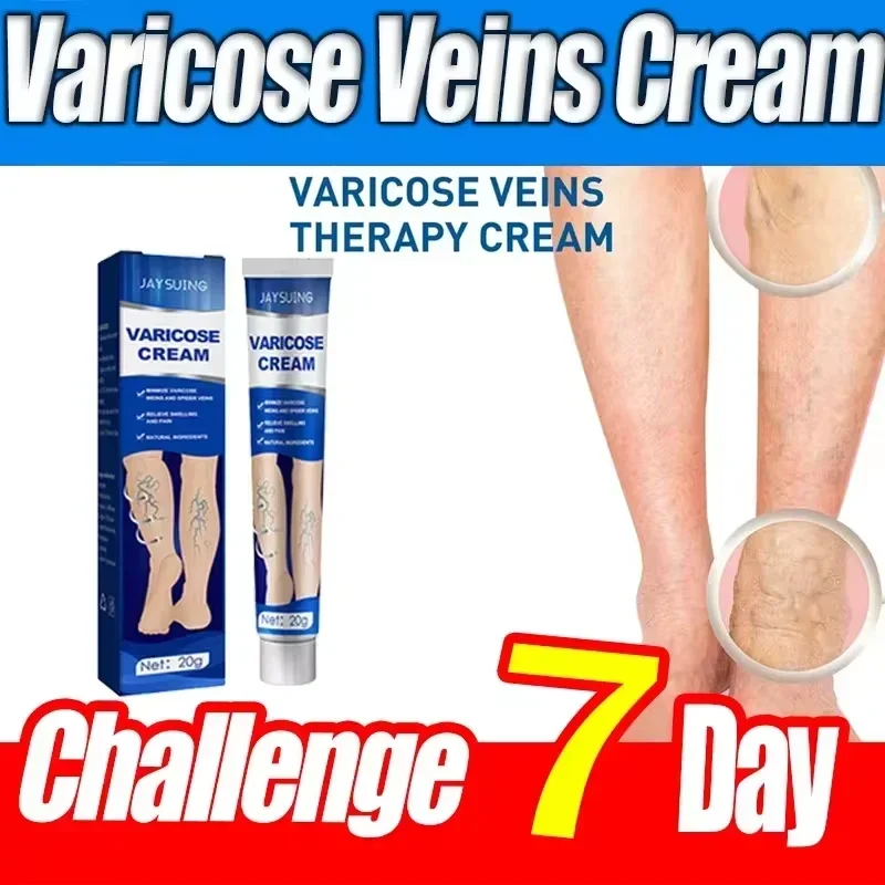 

Ointment for Varicose Veins Eliminate Vasculitis Phlebitis to Relieve Spider Leg Pain Treatment Herbal cream