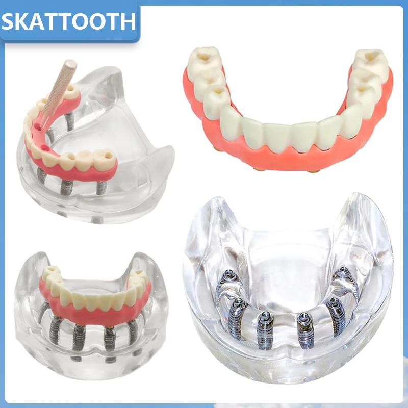 Dental Implant Model with Implant Overdenture Inferior Lower Tooth Implant Removable Model for Dentist Teaching Studying Demo