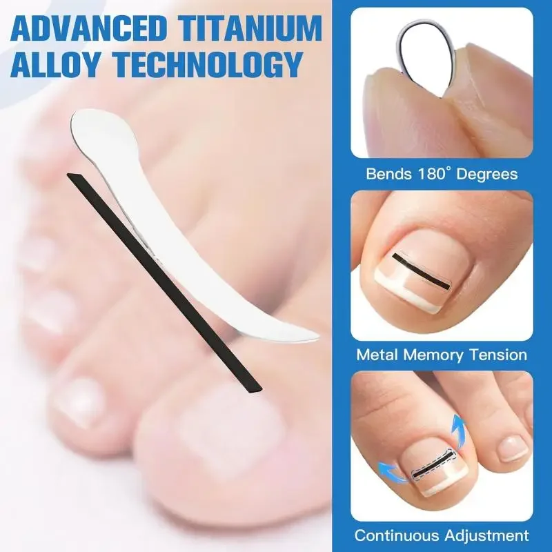 5pcs Ingrown Toenail Correction Tool Ingrown Toe Nail Treatment Elastic Patch Sticker Straightening Clip Brace Pedicure Tool
