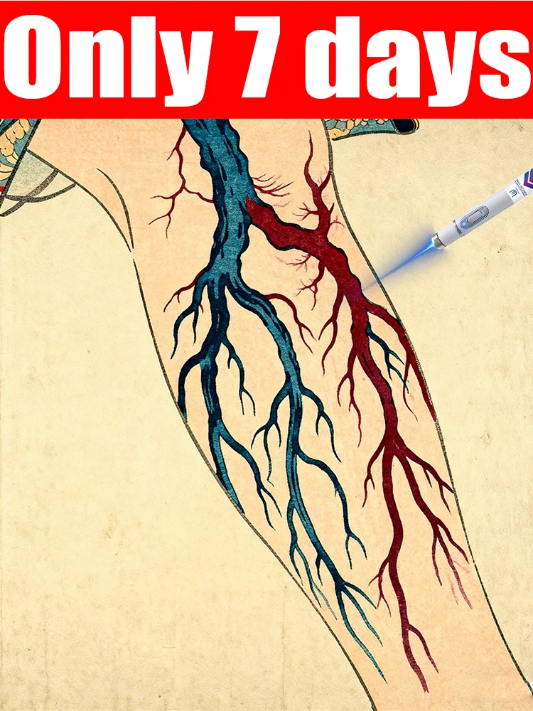 

Vᴀʀɪᴄᴏsᴇ ᴠᴇɪɴ ʟᴀsᴇʀ ɪɴsᴛʀᴜᴍᴇɴᴛ