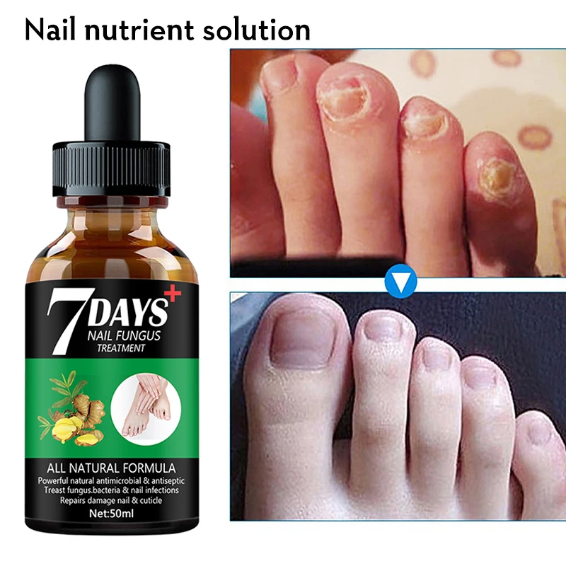 7 Dagen Reparatie Nagel Schimmel Behandelingen Essence Voetverzorging Serum Teen Nagels Schimmelverwijdering Gel Anti-Infectie Onychomycosis(50Ml)