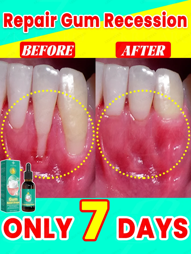 Hot selling tooth drops, repair damaged gums, relieve gum pain, strengthen gums, restore healthy gums! ! ! !