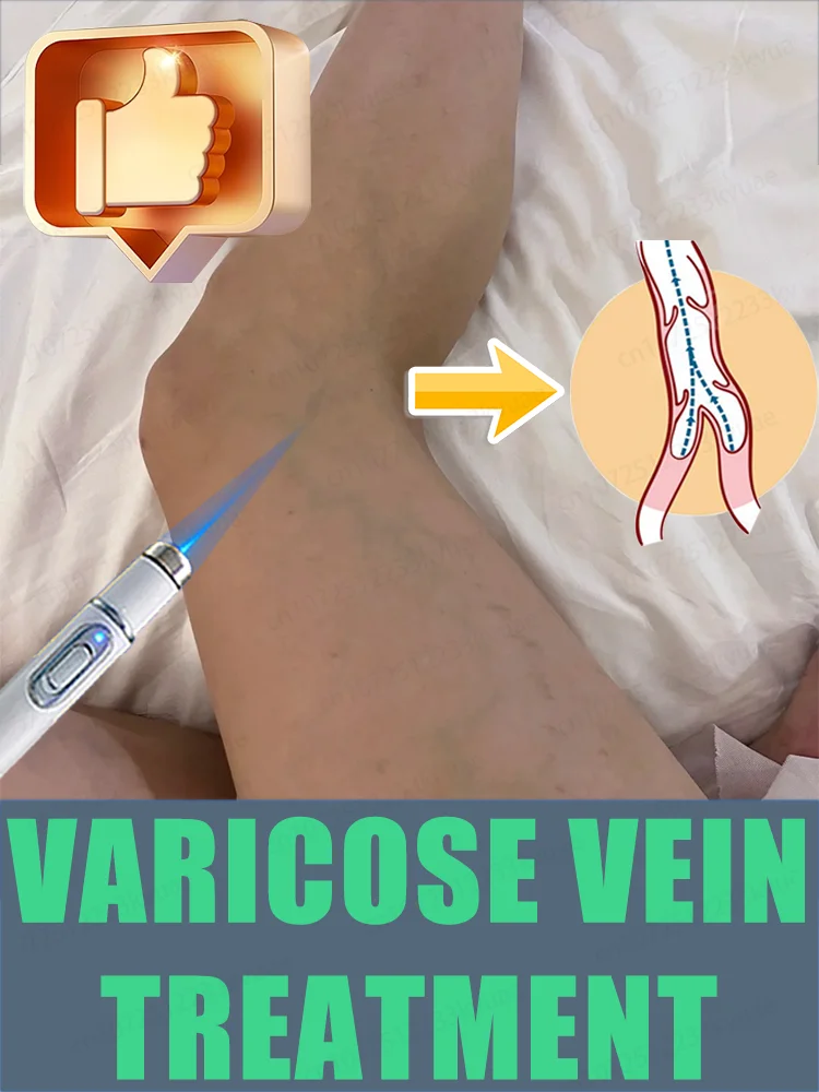 

2nd generation laser venous treatment pen, used to treat varicose veins
