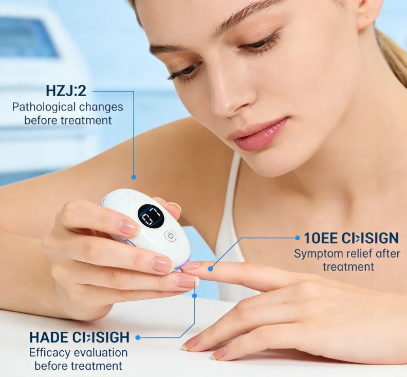 HZJ02 Nail Fungus Laser Device 905nm 470nm 650nm 405nm LCD Display 7min Auto Off