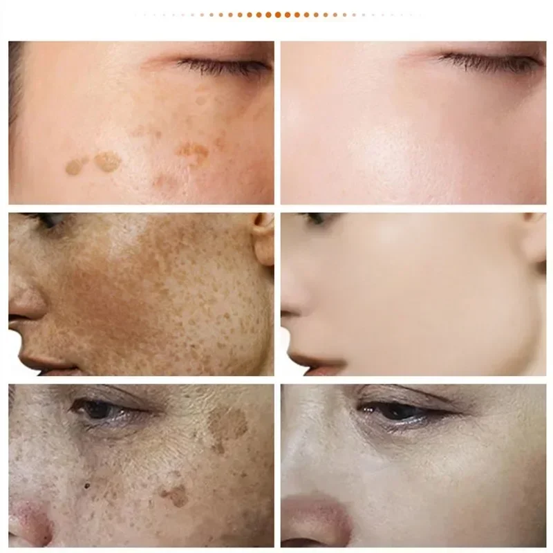 Eelhoe Niacin amid Melasma Aufhellung creme reduzieren Melanin aufhellen Creme aufhellen dunkle Haut Chloasma Serum verblassen feine Gesichts linien