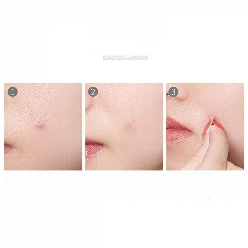 36/72/180/360/720 Stuks Ronde Acne Patch Hydrocolloid Anti Acne Patches Waterdicht Gezicht Huidverzorging Comedondrukker puistje Patches