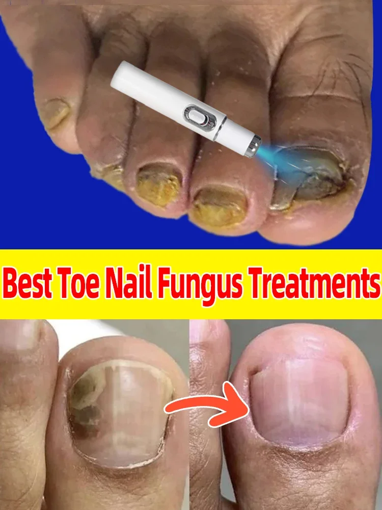 Hot Selling Laser Product For Solving Nail Problems