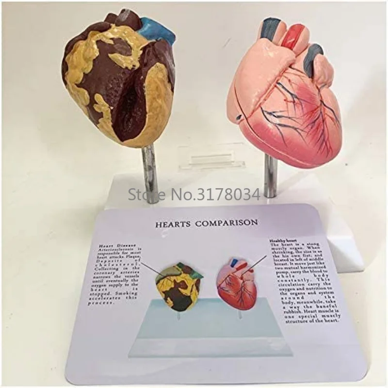 Human Heart Model Pathological Anatomical Heart Model Health and Smoking People Heart Comparison Model