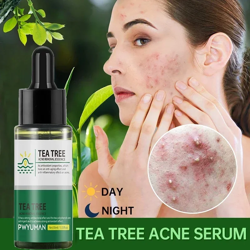 Tea Tree Acne Remoção Soro, Reparar Pimple Spots, Encolhendo poros, Remover cravos, Limpeza Facial, Fade Acne Marks, Clareamento da pele