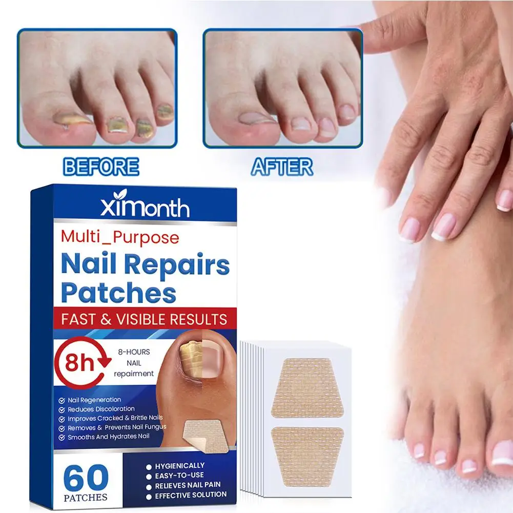 60pcs Toenail Fungus Treatment Stickers Ingrowning Toenail Corrector Paronychia Treatment Patch Fungus Removal Nail Repair Patch