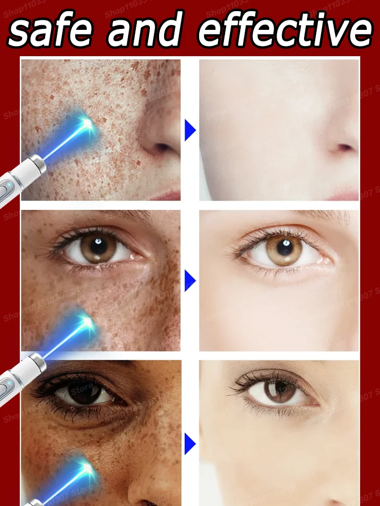 

Freckles Melasma Melasma Dark Spots on Face Blu-ray pen