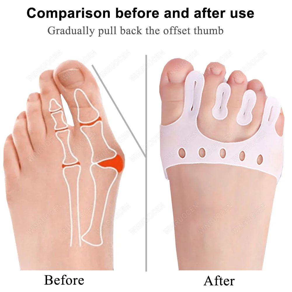 2Pcs=1Pair Silicone Bunion Corrector Separator Pain Relief Shoes Insoles Finger Toe Hallux Valgus Corrector Forefoot Pads Care