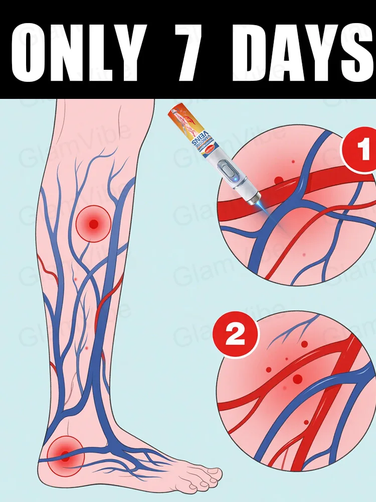 

Generation-2 Laser Says Goodbye To Spider Legs Varicose In 7 Days