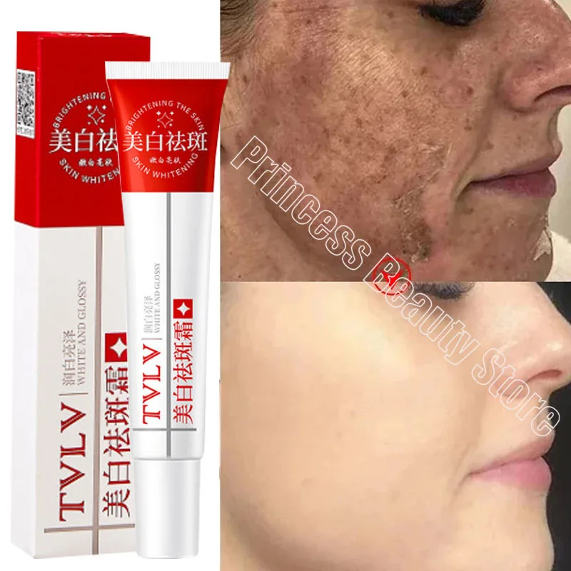 Whitening Freckle Cream Melasma Dark Spots Pigmentation Removal Products Fade Stain Melanin Repair Brighten Korean Skin Care