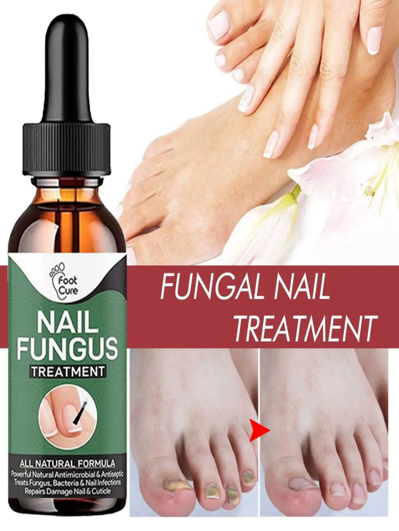 Nail Fungus Treatment Feet Care Essence Nails Foot Repair Toe Nail Fungal Removal Onychomycosis Gel Anti Infection Paronychia