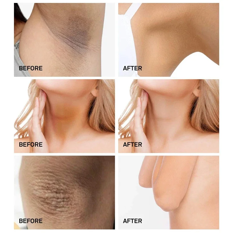 كريم تبييض الجسم تحت الإبط أجزاء خاصة مصل تبييض بعقب الركبة سطع الفخذ الداخلي الميلانين الحميم العناية بإزالة الداكن #4