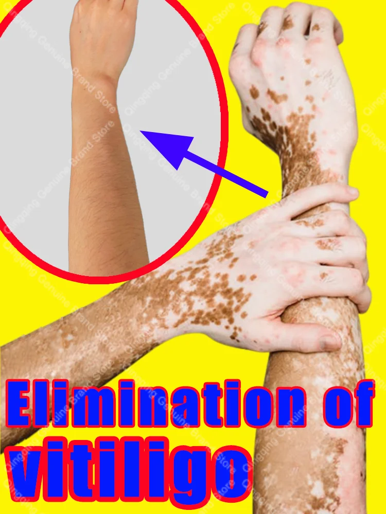 

Vitiligo Cream Melanin Growth