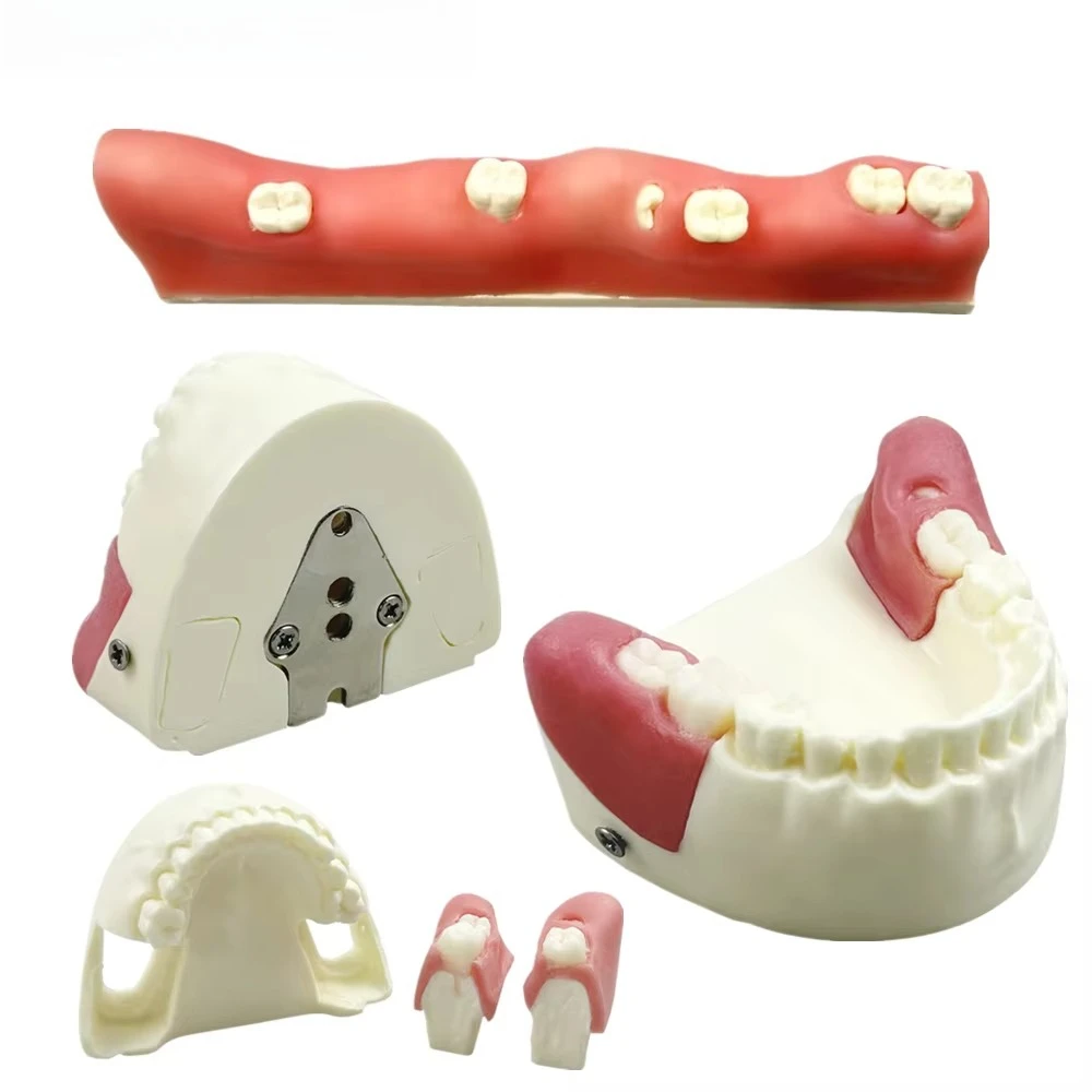 Dental Impacted Tooth Model Unerupted Tooth Extraction Practice Model Detachable Wisdom Teeth For Training Teaching Studying