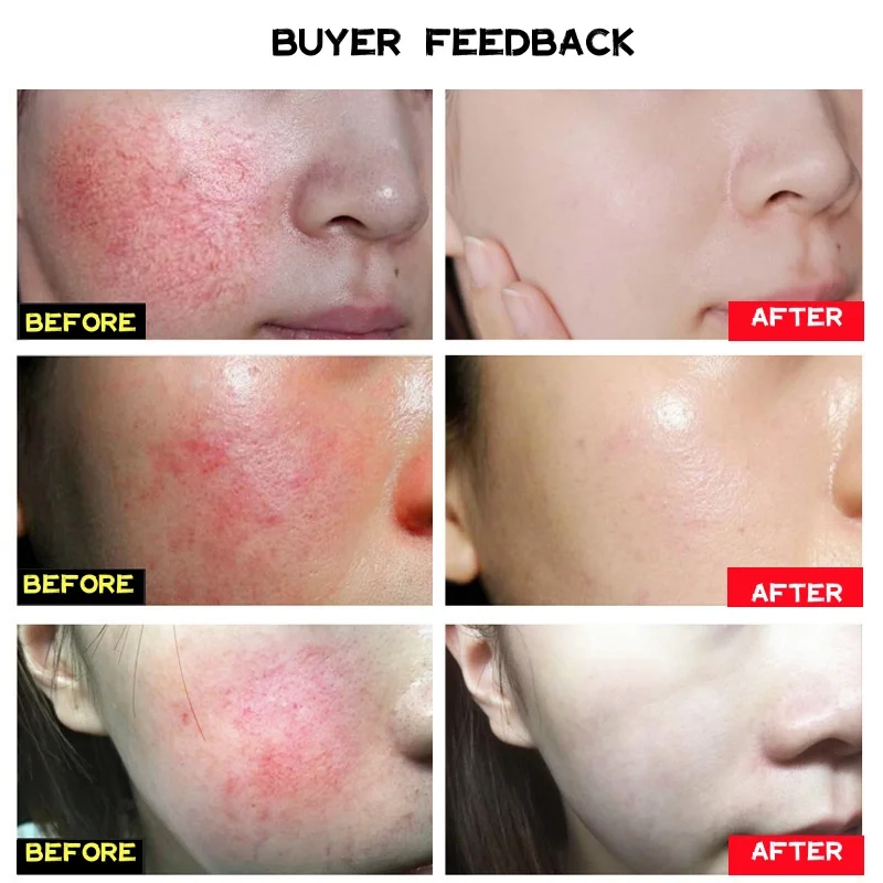 Repair Facial Redness Serum Instant Spider Vein Remove Sensitive Skin Sooth Anti Redness Rosacea Treat Lotion Korean Cosmetics