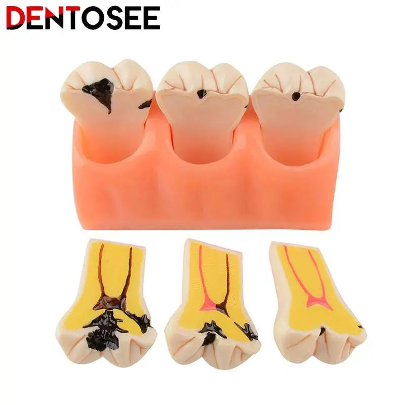 

4X Denture Caries Disease Tooth Model Decomposition Decay Tooth Model Dental Teaching Tools