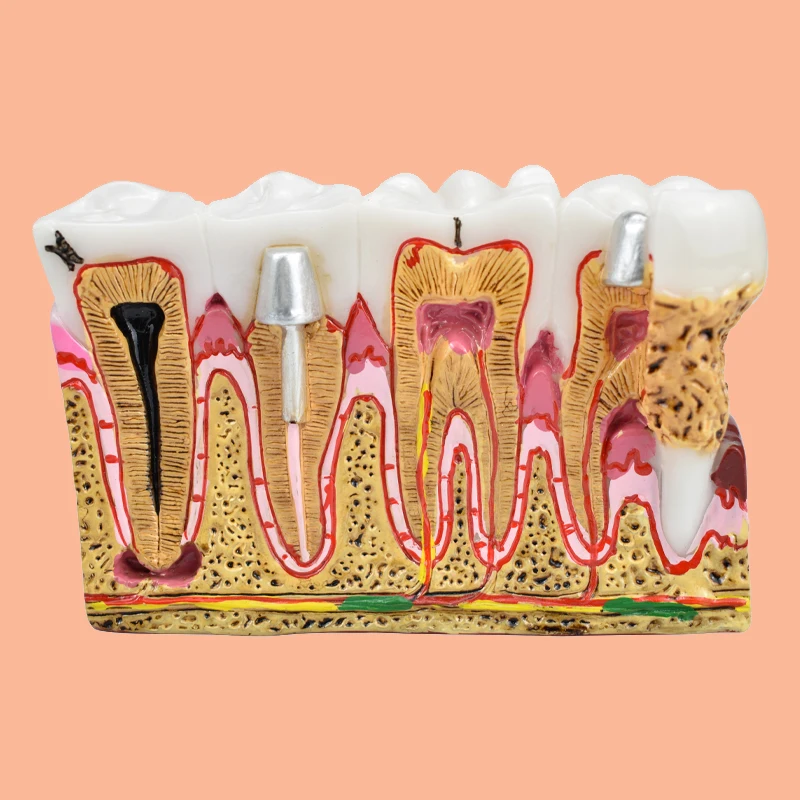 

Dental Caries Anatomy Comprehensive Pathology Nerve for Oral Teaching Teeth Model