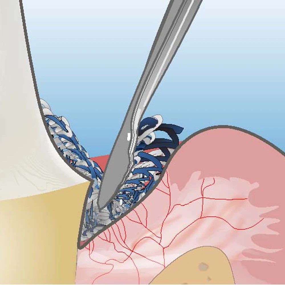 Ultradent fischer ultrapak packers gingival retraction cabo aplicador fino serrilhado instrumentos de embalagem odontologia ferramentas