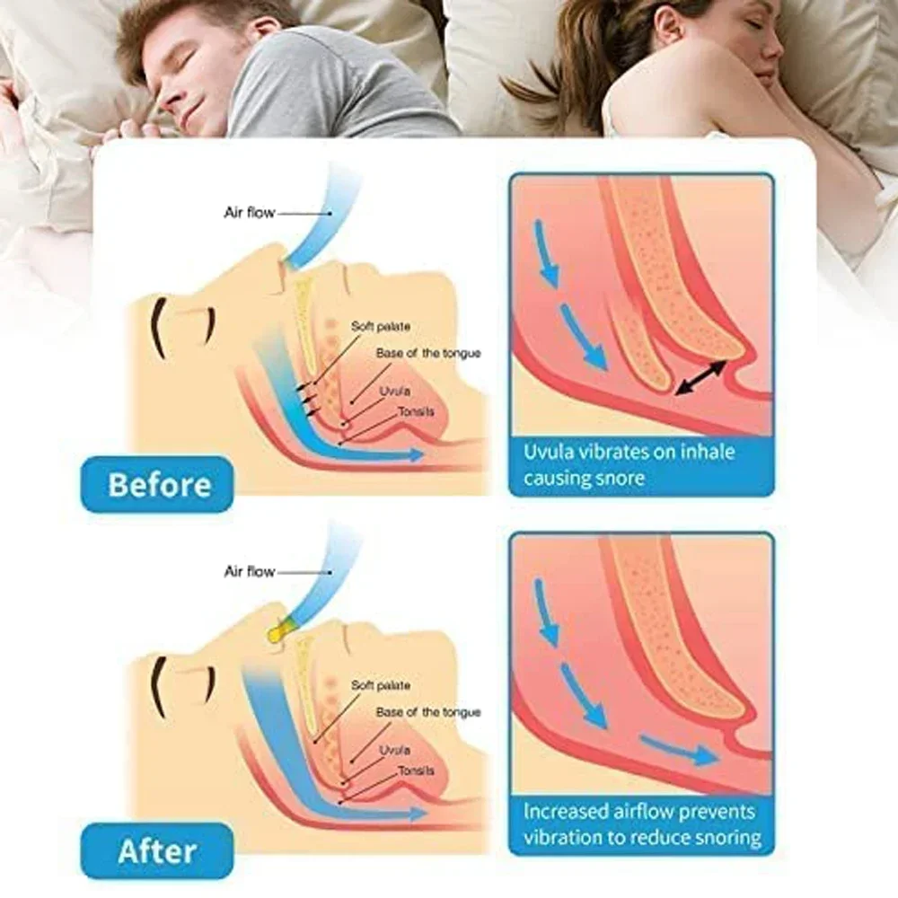 Medical Anti Snoring Nose Clips Sleeping Aids Stop Snore Device Nose Vent Nasal Dilator Sleep Snor Solution anti Snor Apnea