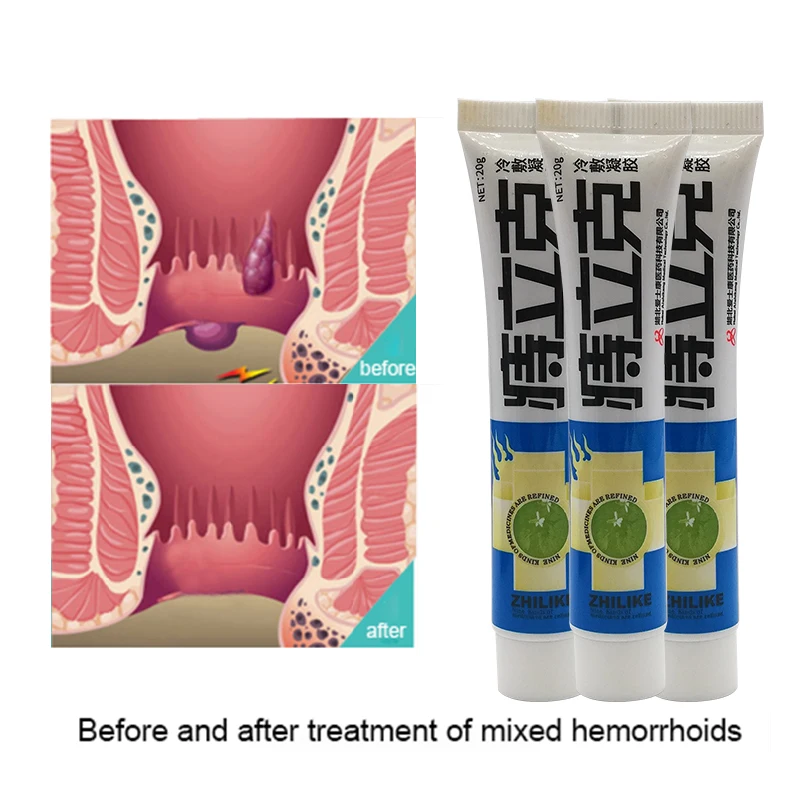 Hemorrhoid Ointment Treat Internal And External Hemorrhoid Anal Pain Itch Relief Cream Powerful Hemorrhoids Cream Huatuo Plaster