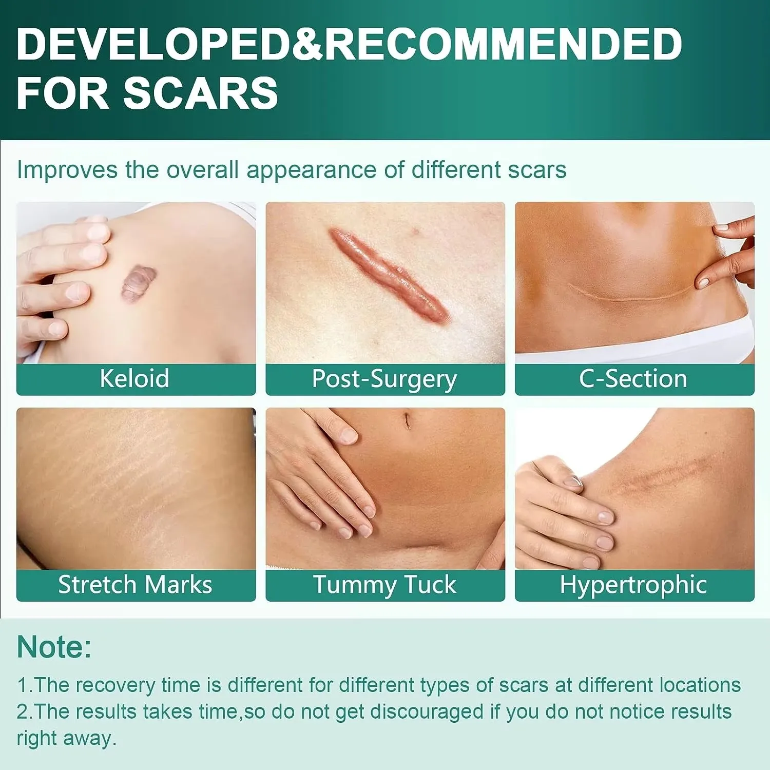 50/100/150 centimetri Gel di Silicone Cicatrice Copriletto Patch Trattamento Rimozione Nastro Acne Trauma Bruciare Cicatrice Copertura Sezione di Riparazione Della Pelle Orecchio bellezza