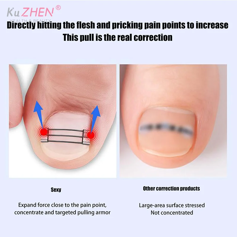 1세트 내향성 발톱 교정 클립 보조 도구 페디큐어 회복 내장형 발톱 치료 전문가용 내향성 발톱 교정기
