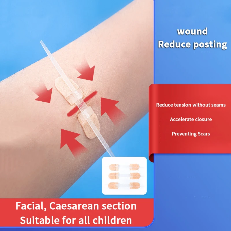 Zipper Tie Wound Closure Patch Hemostatic Patch Wound Fast Suture Zipper Band-Aid Outdoor Portable Bandages For Wound Care