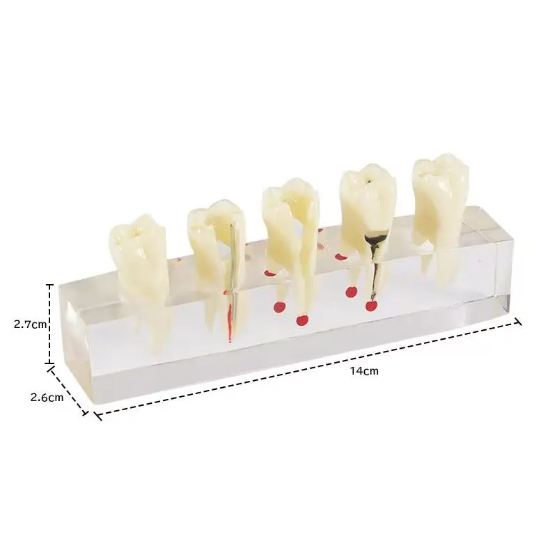 1 Set Dental Oral Root Canal Model Demonstration Tooth Decay Caries Development Teaching Practice Model For Root Canal Treatment