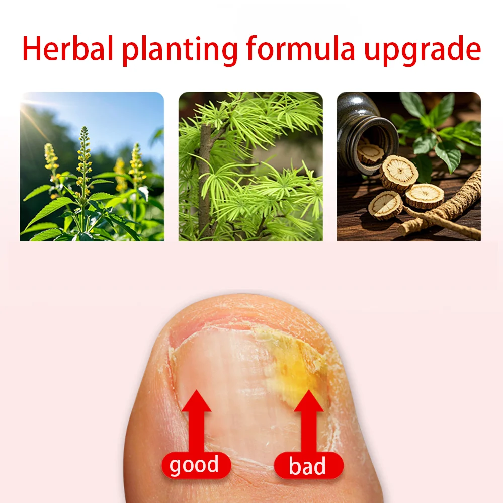 Zehennagel Nagel Pilz Behandlung Serum Fuß Reparatur Flüssigkeit Entfernung Ätherische Öle Fuß Nagel Pilz Reparatur Gel Hand Fuß Pflege