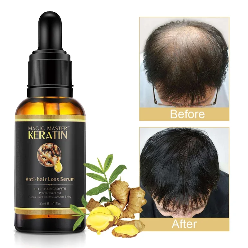 MMK Hair Growth Oil Ginger Extract Growing Serum Prevent Hair Loss Care Scalp Massage Roller Treatment Thickener Essence 30ml