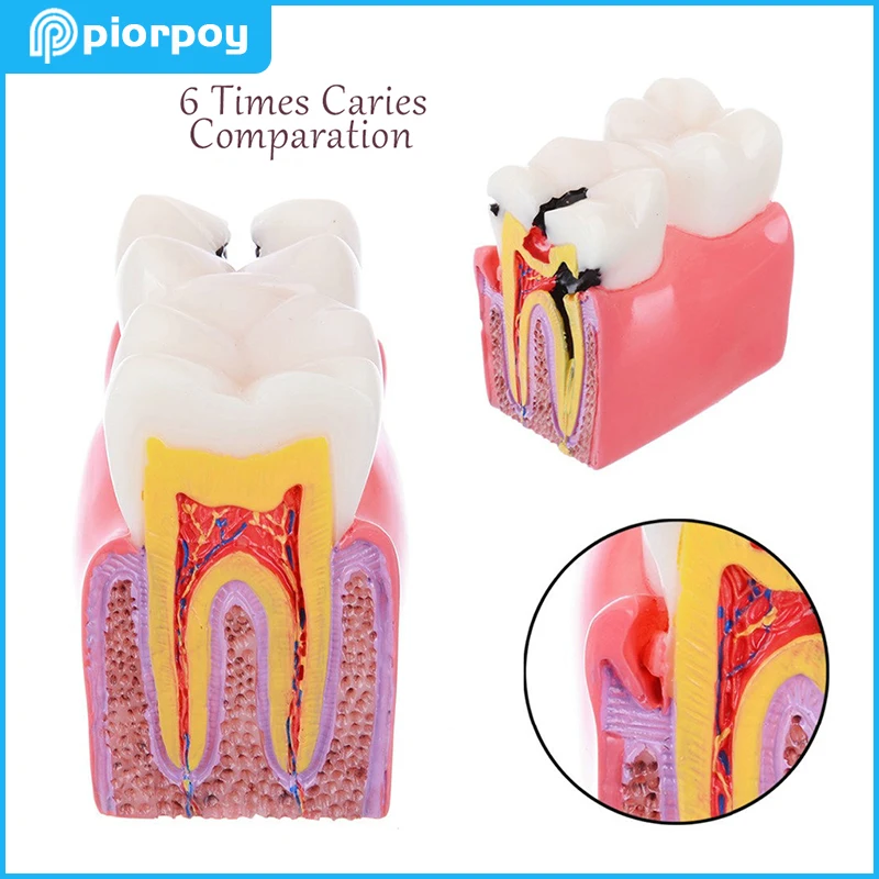 

PIORPOY 1Pcs Dental Models 6 Times Caries Comparation Decomposition Dentistry Lab Teaching Student Studying Typodont Teeth Model