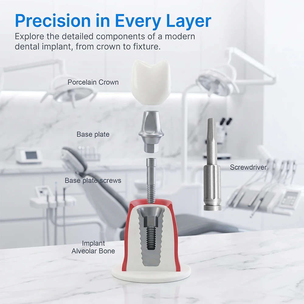Detachable Dental Tooth Crown Abutment Screw Implant Structure Teaching Study Demonstration Model Dentist Education Display Tool