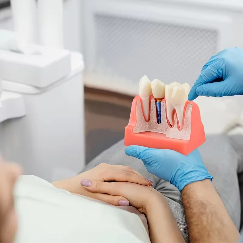 4 Times Dental Implant Demonstration Model, Removable Crown Bridge Teeth Analysis Model Dental Teaching Tool for Denti
