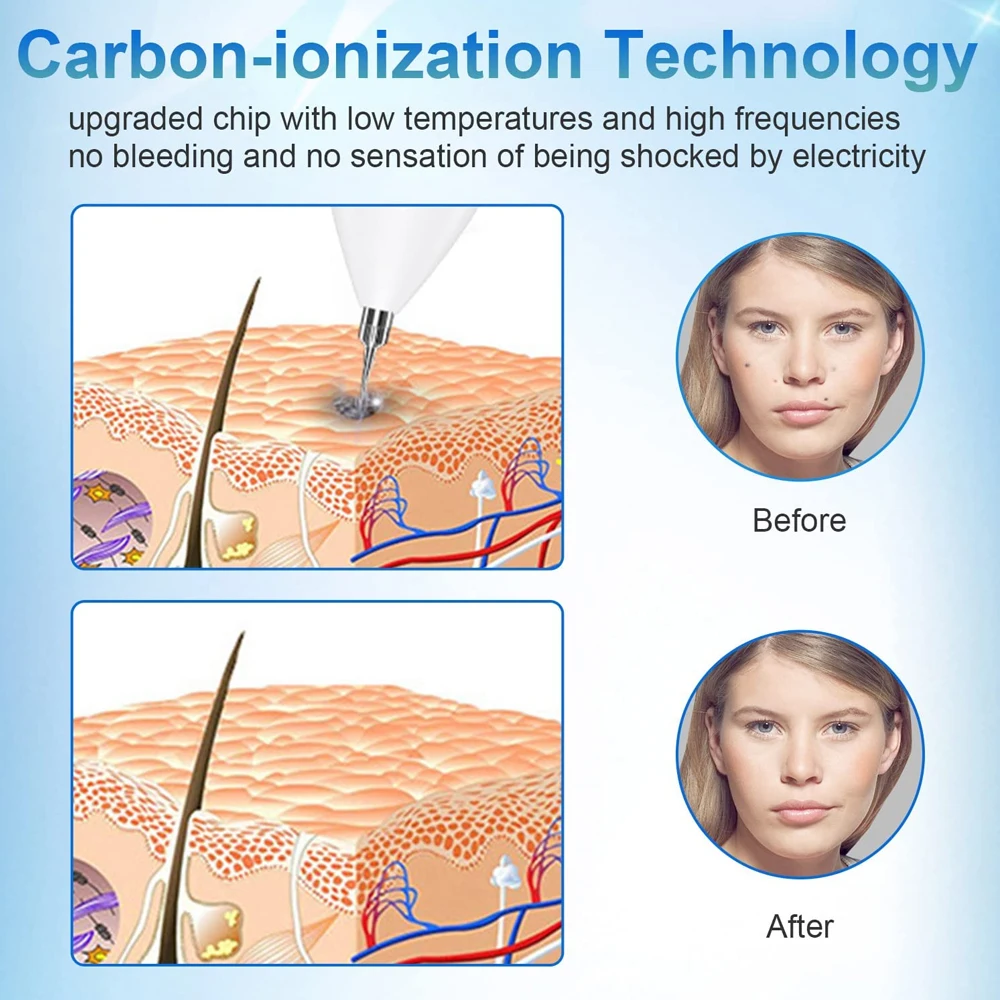 Upgrade Mole Entferner Stift Tragbare Haut Tag Entferner Stift mit 9 Festigkeit Ebenen für Gesicht Körper Warze Sommersprossen Naevus Spot behandlung