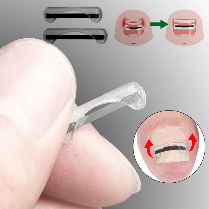 Cable de corrección de uñas de los pies de aleación de titanio, dispositivo de tratamiento de uñas encarnadas, pegatina, herramienta de silicona, accesorios para el cuidado de los pies, uso diario, 15/17MM