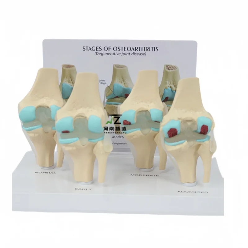 4 Stage Knee Joint Model With Back Clamp Disease Knee Joint Model Orthopedic Teaching Display Model Factory Direct Sales